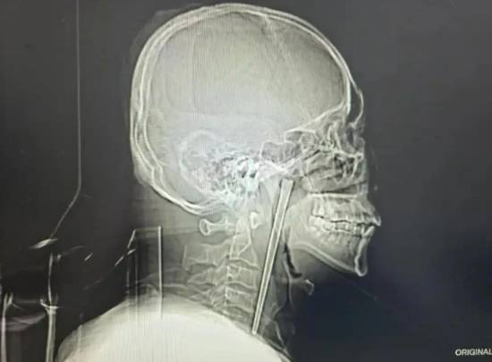 男子误吞12厘米筷子忍了8年才取出 网友：是个狠人